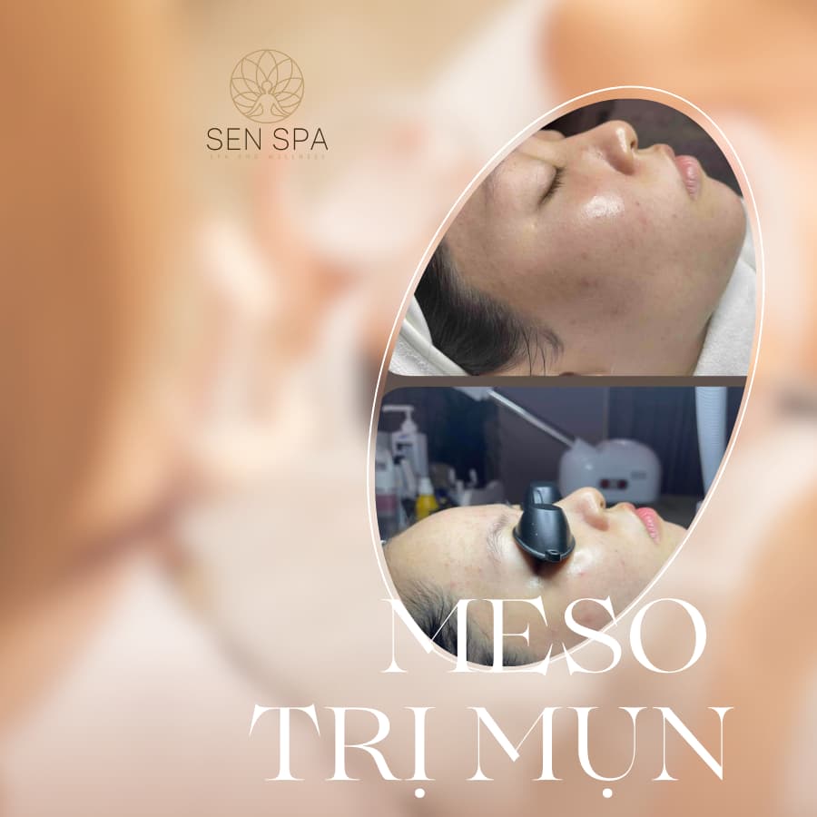 Meso trị mụn tại Long Biên: Cải thiện 