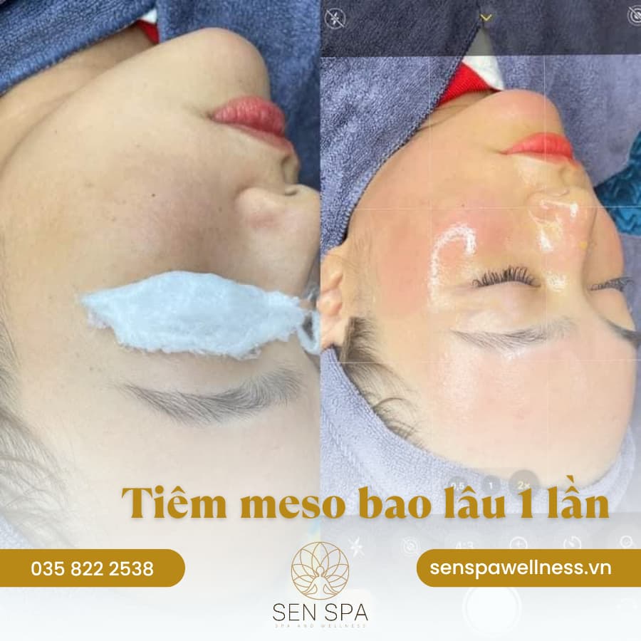 Tiêm meso bao lâu 1 lần tại Long Biên, có mang lại hiệu quả vĩnh viễn không?