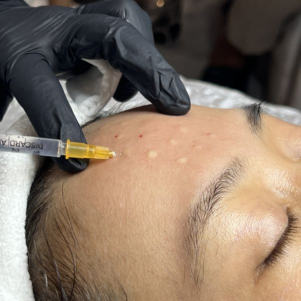 Tiêm meso là gì? Lợi ích phương pháp tiêm meso tại Sen Spa ở Long Biên