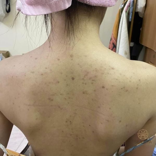 Trị mụn ở Long Biên