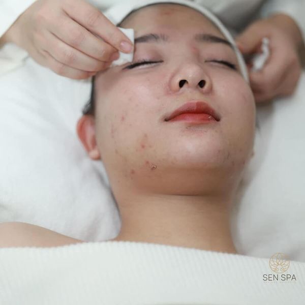 Quy trình chăm sóc da mụn hàng ngày