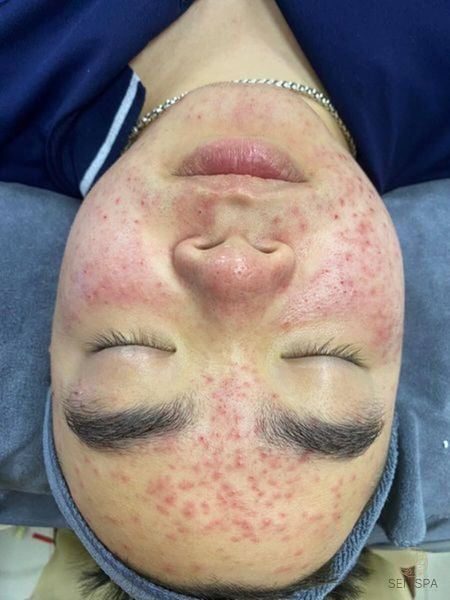 Trị mụn ở Long Biên