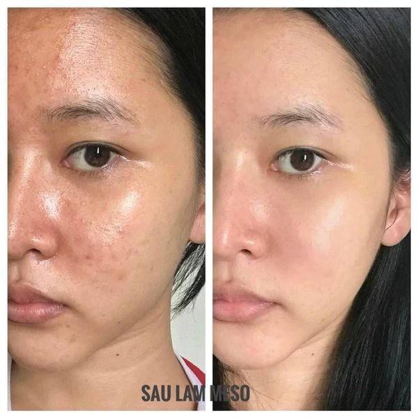 Nên tiêm meso không