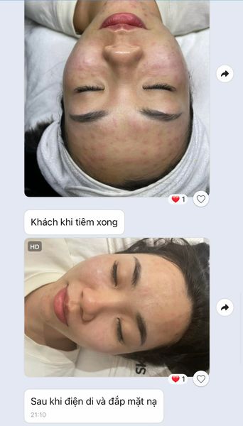 Tiêm meso căng bóng da