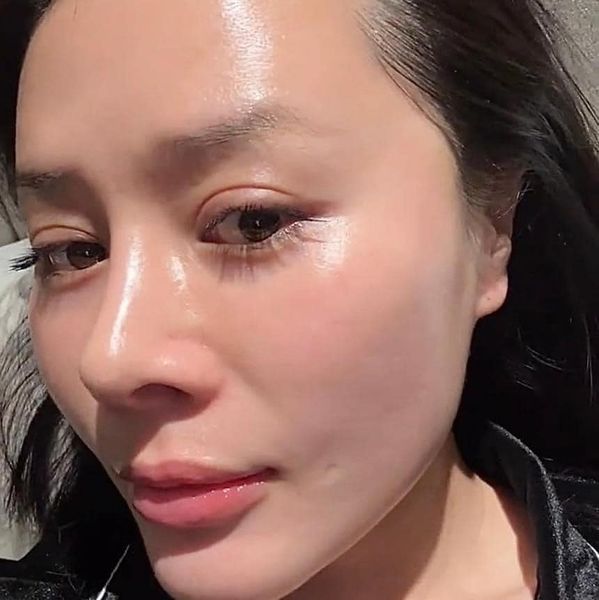 Tiêm meso căng bóng da