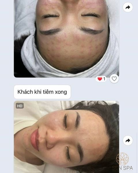 Địa chỉ tiêm meso uy tín