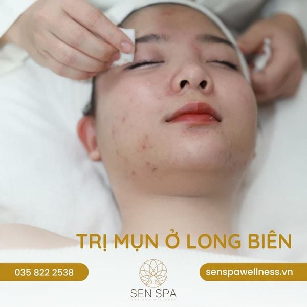 Trị mụn ở Long Biên