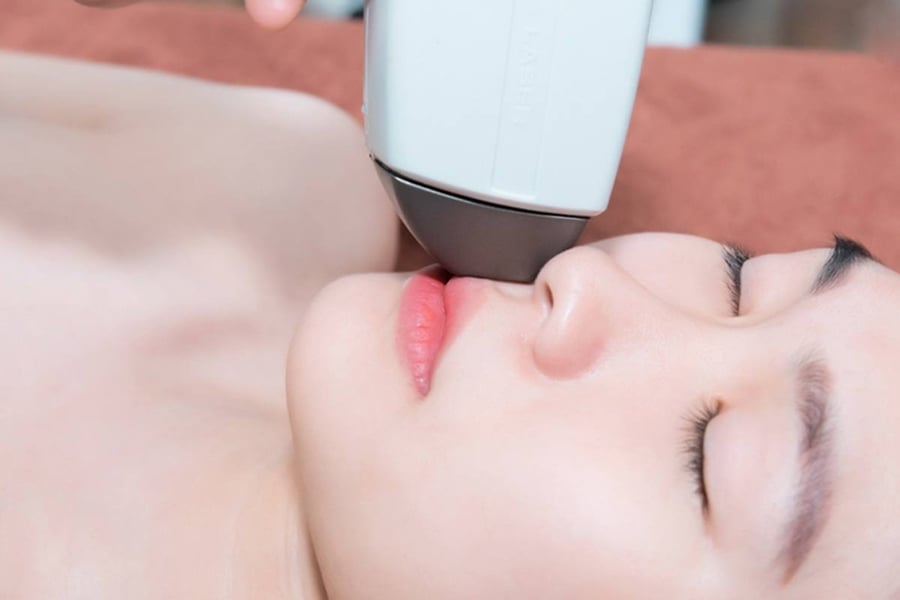 Triệt ria mép bằng công nghệ hiện đại