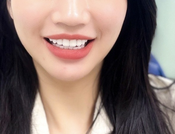 Content về sức khỏe - Kinh nghiệm làm răng sứ