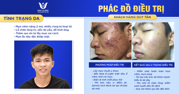 Review kết quả điều trị mụn viêm nang do kem trộn & cạy nặn tại nhà khách hàng Duy Tân