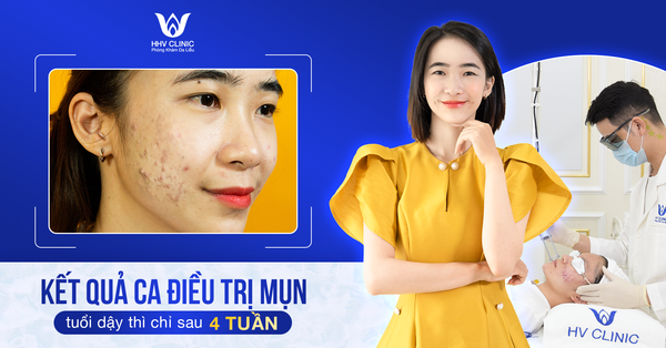 Trả kết quả ca điều trị mụn tuổi dậy thì chỉ sau 4 tuần hiệu quả an toàn