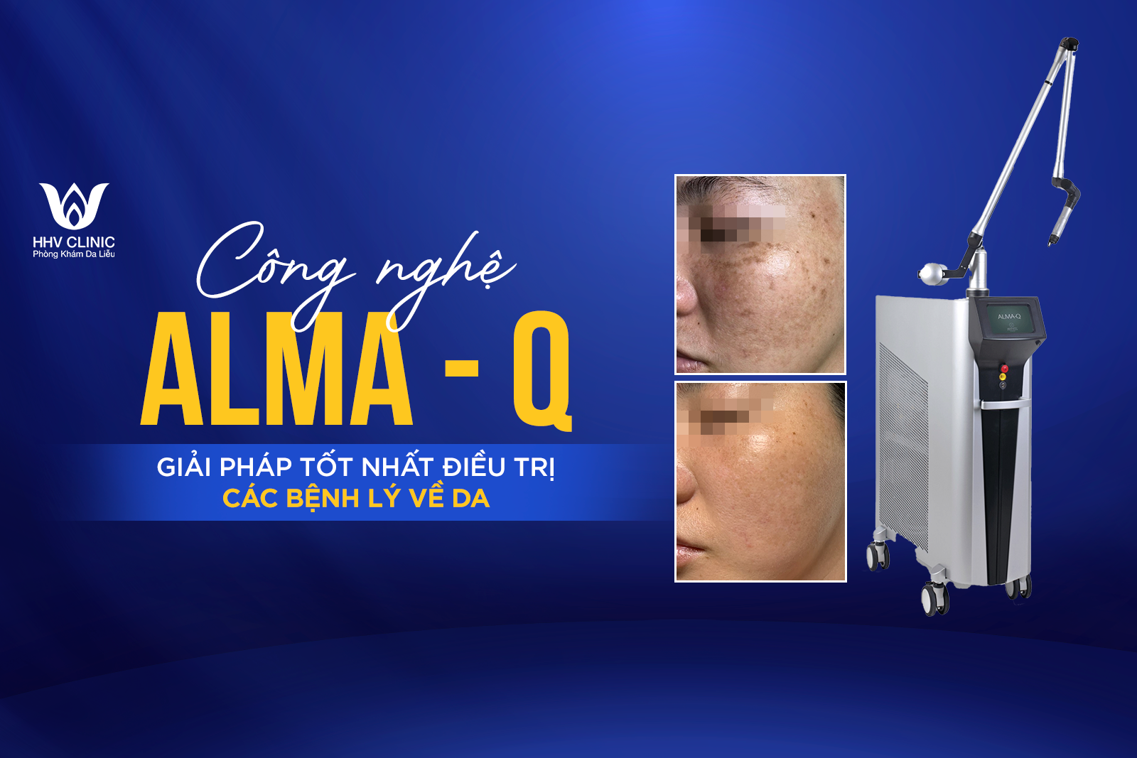 Công nghệ ALMA - Q: Giải pháp tốt nhất điều trị các bệnh lý về da
