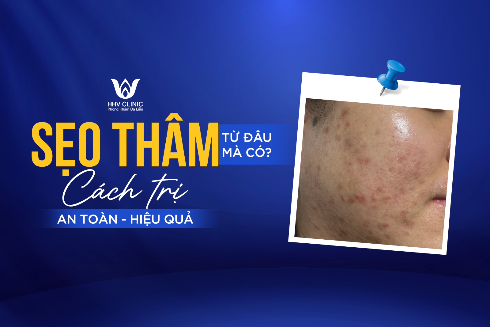 Sẹo từ đâu mà có – Cách trị sẹo an toàn hiệu quả nhất