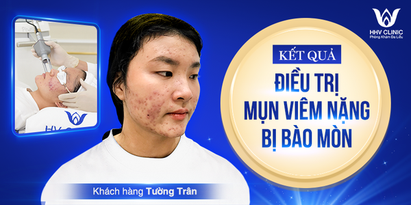 Kết quả điều trị mụn viêm nặng bị bào mòn khách hàng Tường Trân