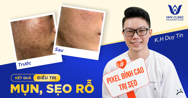 Kết quả điều trị mụn, sẹo rỗ của K.H Duy Tín