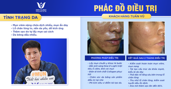 Review điều trị mụn viêm, da bóng dầu mỏng yếu do rượu thuốc