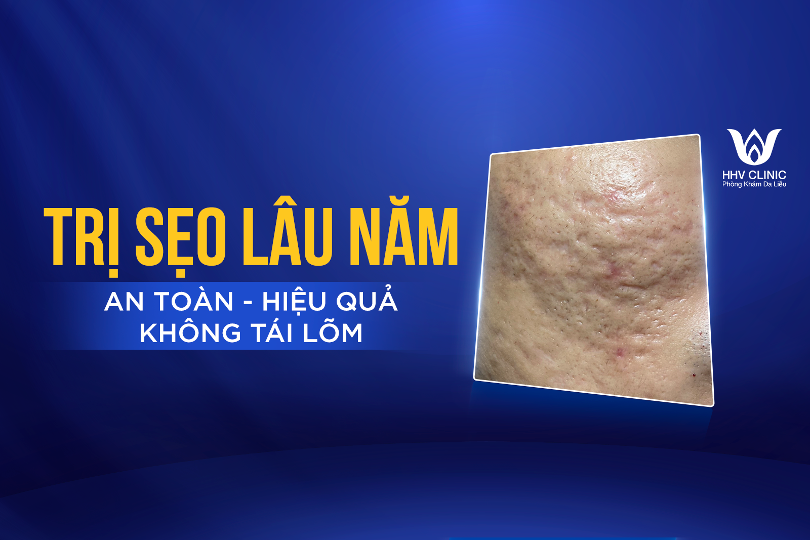 Trị sẹo lâu năm an toàn, hiệu quả, không tái lõm