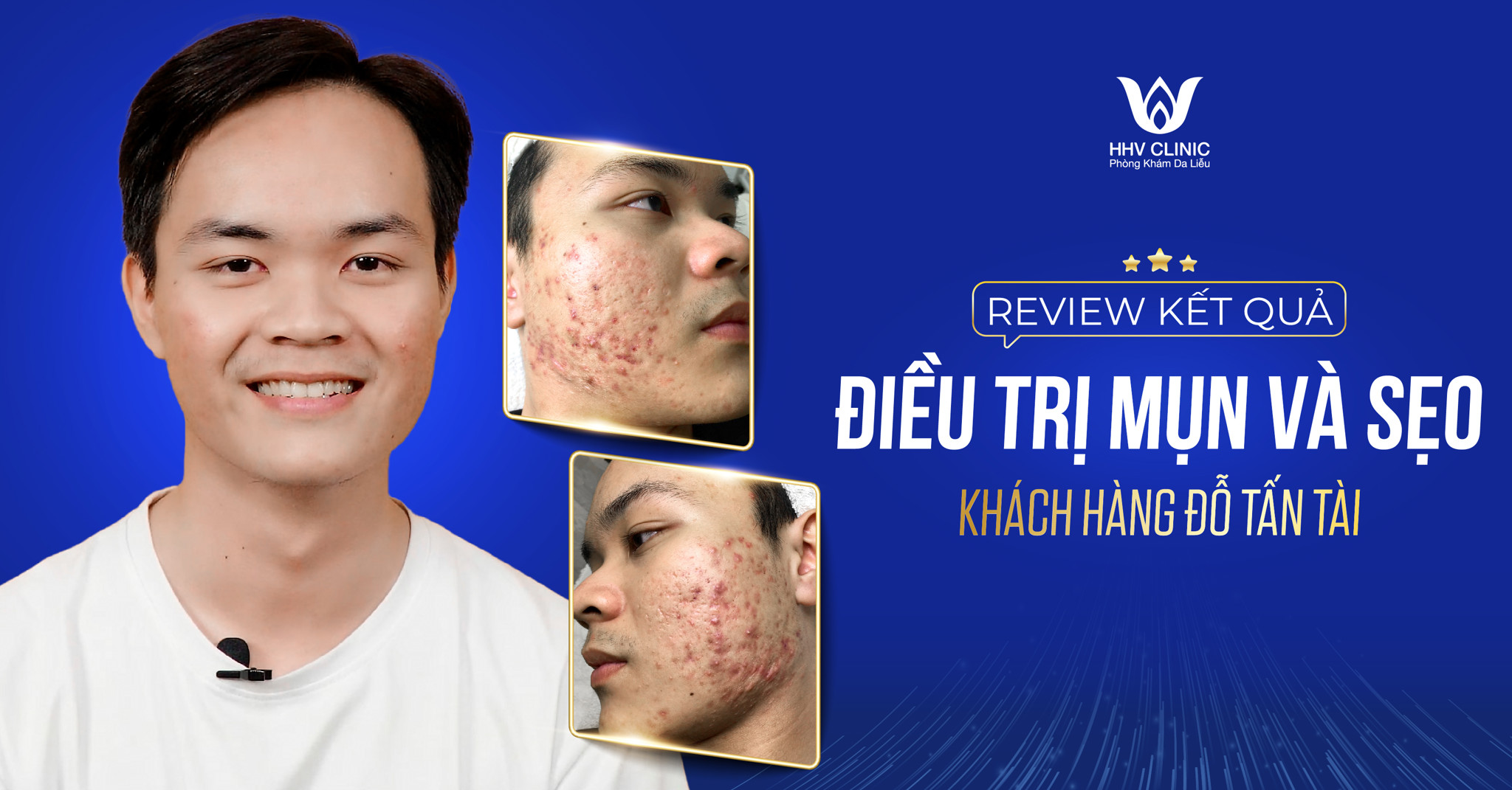 Review kết quả điều trị mụn và sẹo của Khách hàng Đỗ Tấn Tài