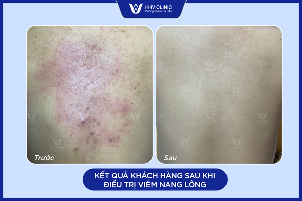 Hiệu quả điều trị viêm nang lông tại HHV Clinic