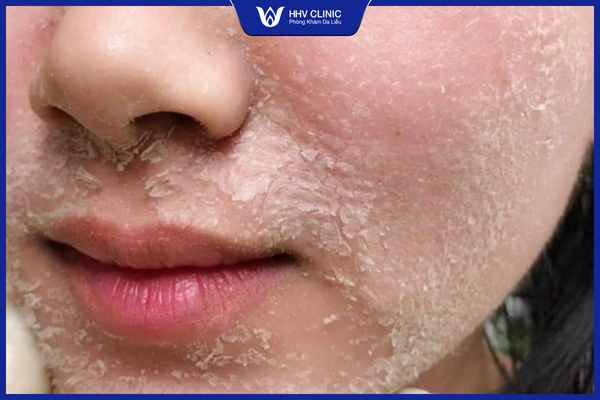 Peel da trị nám chỉ hiệu quả trên bề mặt da