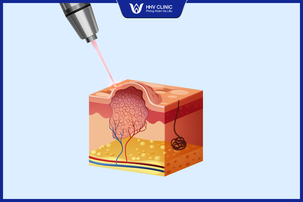 Công nghệ Laser điều trị mụn thịt hiệu quả