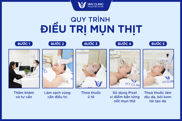 Quy trình trị mụn thịt chuẩn Y khoa tại Phòng khám da liễu HHV Clinic