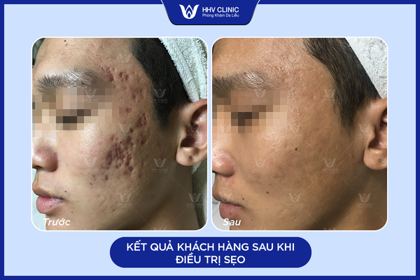 Kết quả khách hàng sau khi điều trị sẹo tại HHV Clinic