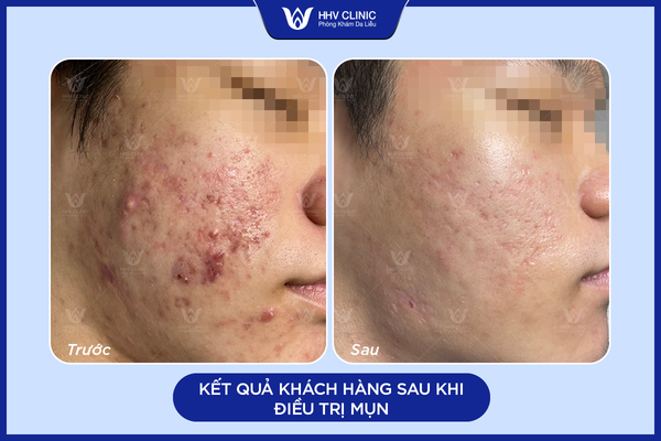 Kết quả khách hàng sau khi điều trị mụn tại HHV Clinic