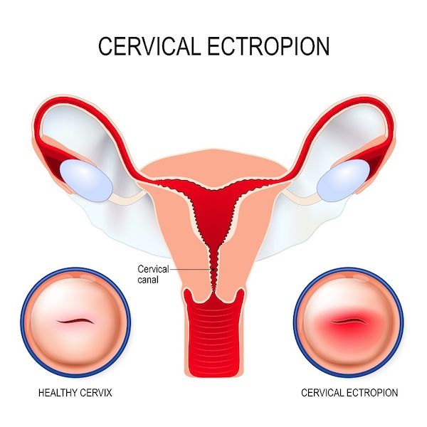 Cervical Ectropion Symptoms Causes And More Ivfholymothers