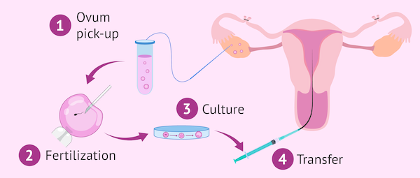 IVF After Tubal Ligation – Procedure, Recovery & Side Effects ...