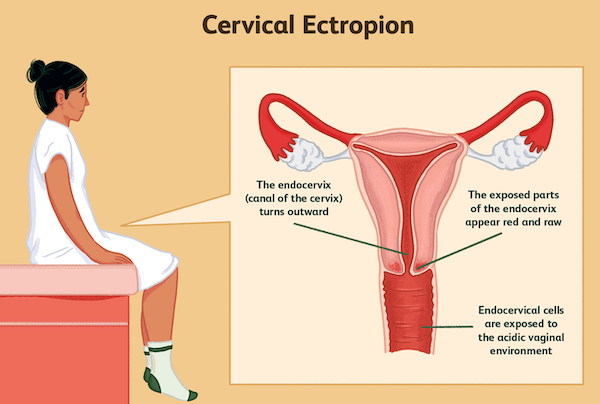 Cervical Ectropion Symptoms Causes And More Ivfholymothers