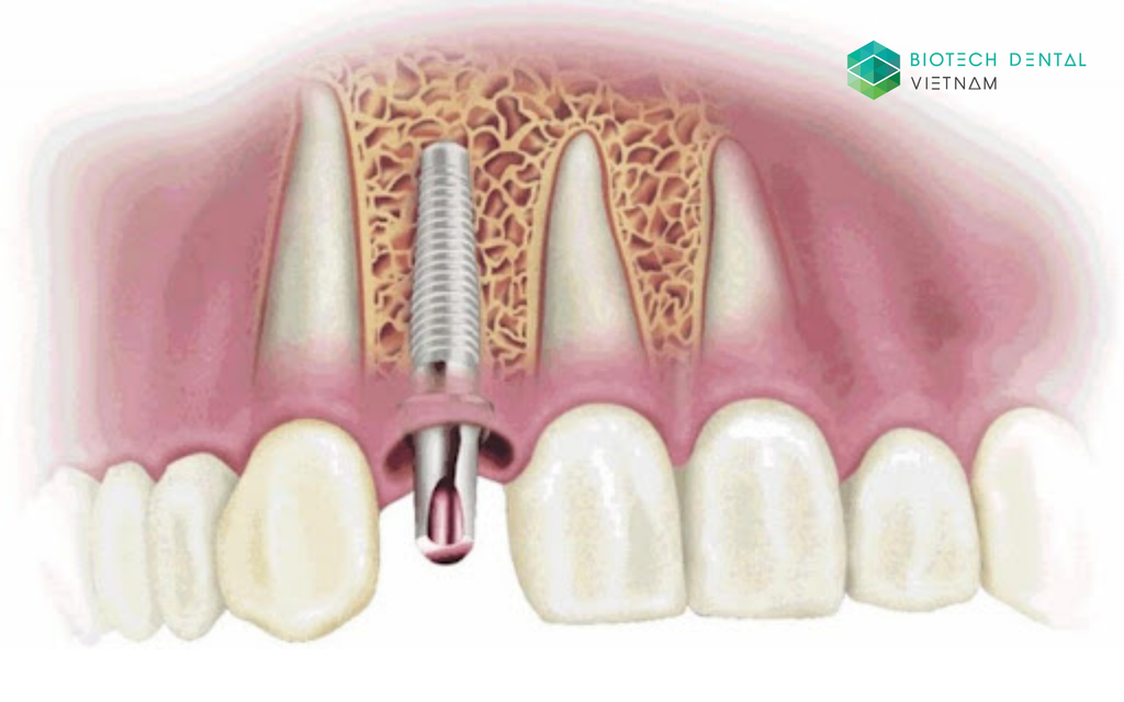 Nguyên nhân thất bại và phương pháp đảm bảo tích hợp xương trong cấy ghép Implant