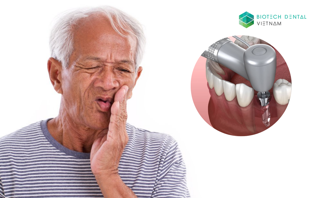 ​​​​​​​Những thất bại và biến chứng trong Cấy ghép Implant. Cần chuẩn bị gì trước khi cấy ghép Implant?