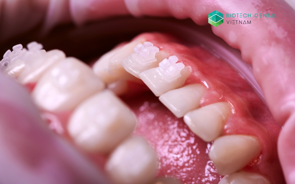 Thiết kế và tối ưu attachment trong chỉnh nha trong suốt với Smilers