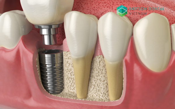 Tầm quan trọng của sự ổn định trong cấy ghép Implant