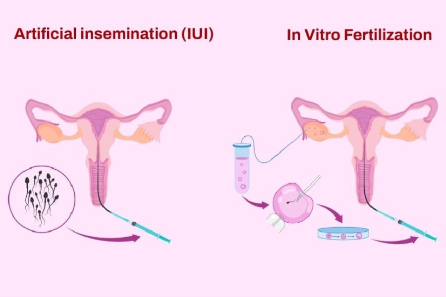 nhathuocvietnhat.vn - Bổ sung 5-MTHF giúp tăng tỷ lệ thành công cho phụ nữ thực hiện thụ tinh nhân tạo