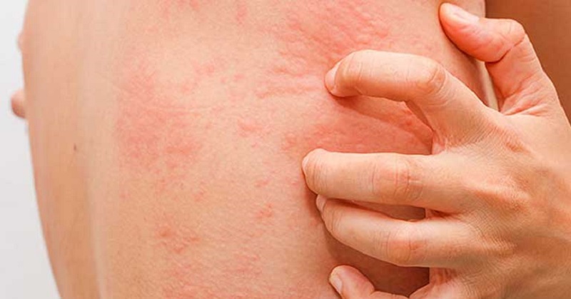 Cơ Thể Nóng Trong – Dấu Hiệu Cảnh Báo Và Giải Pháp Tự Nhiên Từ Thảo Dược