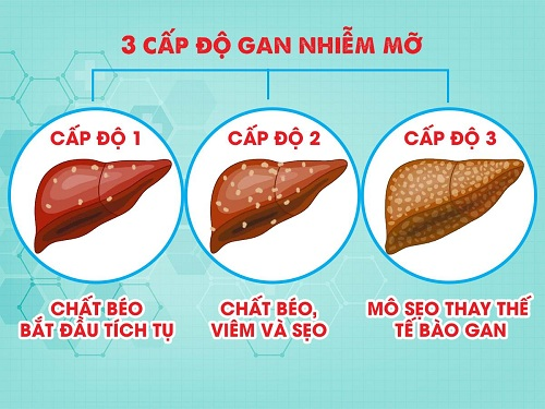 Gan nhiễm mỡ: Triệu chứng và diễn biến theo từng giai đoạn