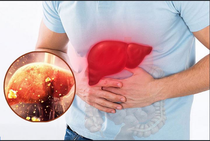 Men gan cao: Dấu hiệu cảnh báo sớm các bệnh lý nguy hiểm về gan
