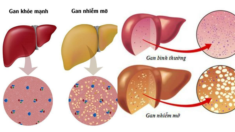 5 Thảo Dược Tự Nhiên Giúp Hỗ Trợ Điều Trị Gan Nhiễm Mỡ Và Cải Thiện Sức Khỏe Gan