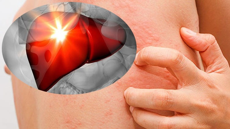 Nóng gan, nổi mụn: Bí quyết thanh lọc cơ thể từ thảo dược thiên nhiên