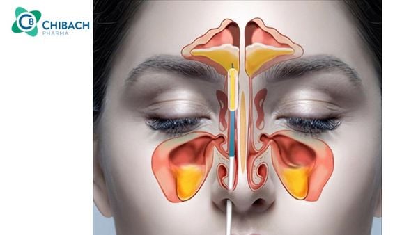 Viêm xoang có mủ: Nguyên nhân, triệu chứng và cách chữa trị tại nhà