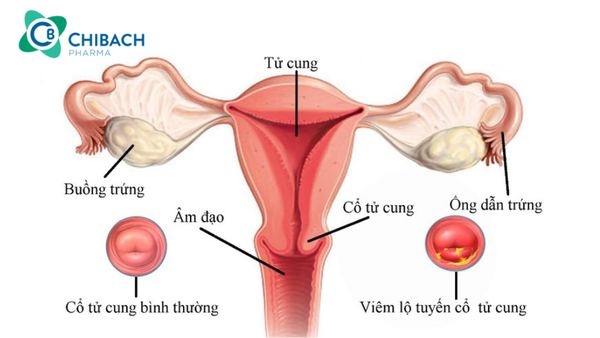 Cách vệ sinh vùng kín khi bị viêm lộ tuyến
