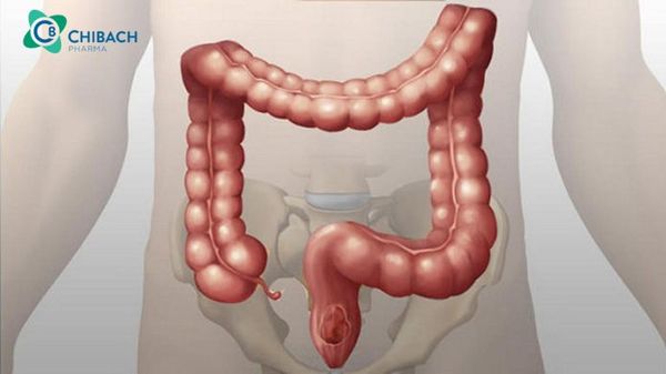 Bệnh viêm ruột già có nguy hiểm không?