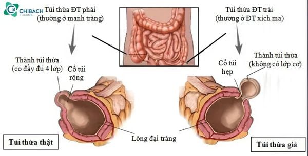 viêm túi thừa manh tràng