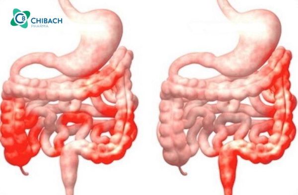 viêm ruột cấp tính