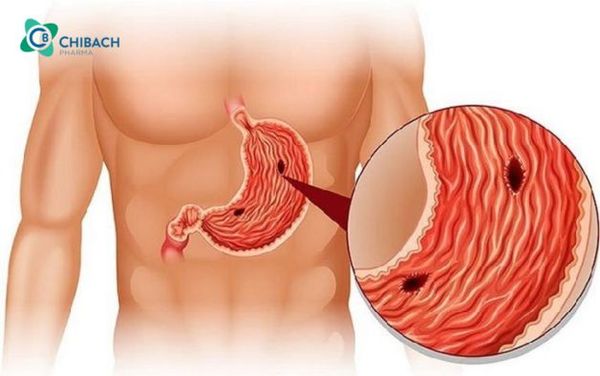 viêm ruột cấp tính