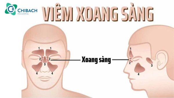 viêm xoang sàng là gì