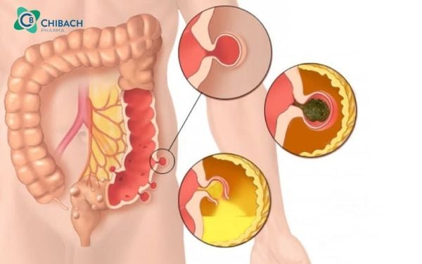 Viêm túi thừa manh tràng