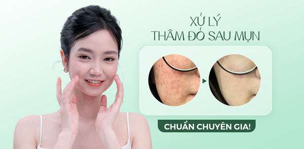 XỬ LÝ THÂM ĐỎ SAU MỤN CHUẨN CHUYÊN GIA